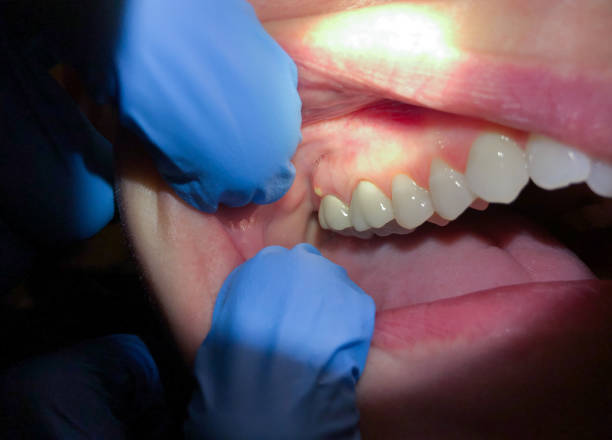 Best Emergency Treatment for Dental Infections or Abscesses in Bono, AR